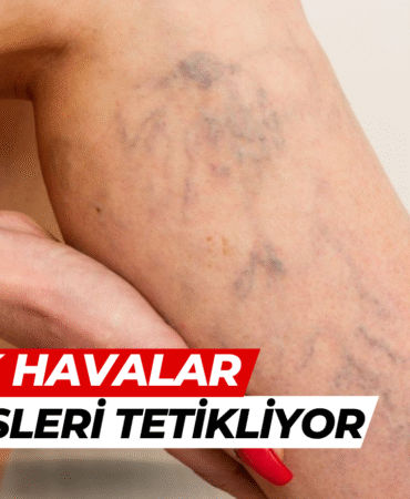sıcak hava varis