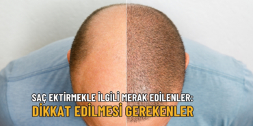 saç ekimi